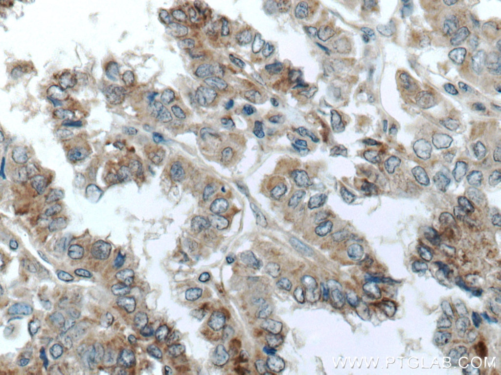 IHC staining of human thyroid cancer using 23899-1-AP