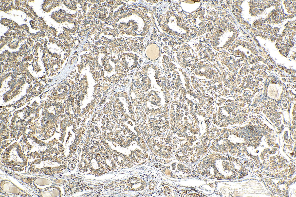 Immunohistochemistry (IHC) staining of human thyroid cancer tissue using TNFSF18 Polyclonal antibody (23899-1-AP)