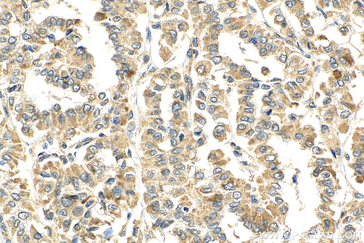 IHC staining of human thyroid cancer using 23899-1-AP