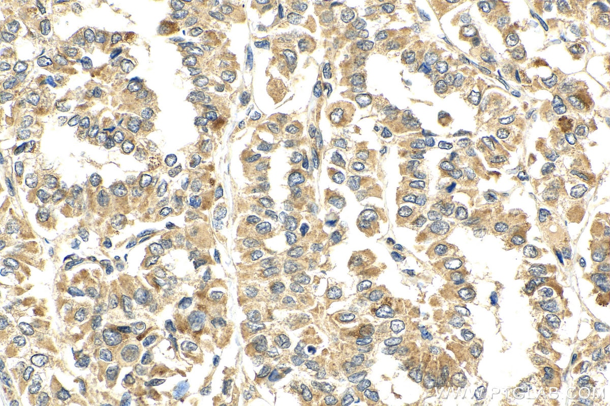 Immunohistochemistry (IHC) staining of human thyroid cancer tissue using TNFSF18 Polyclonal antibody (23899-1-AP)