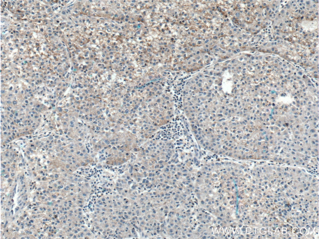 IHC staining of human liver cancer using 17852-1-AP