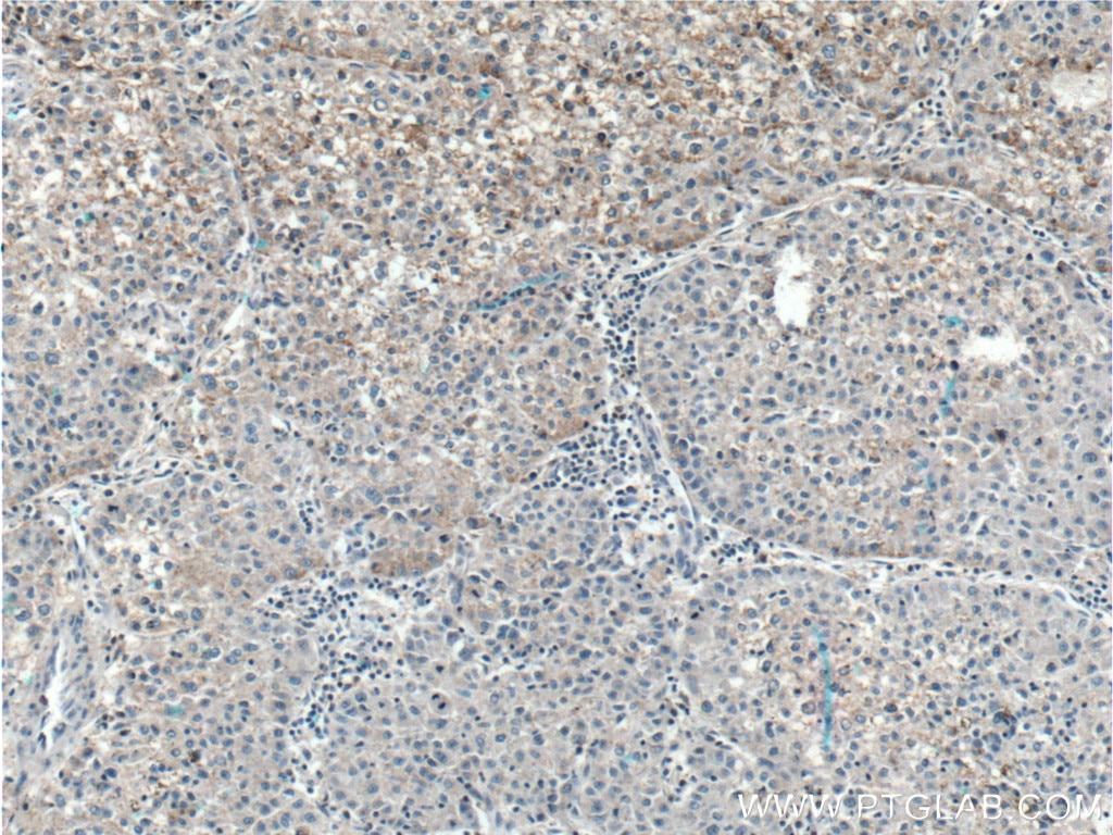 Immunohistochemistry (IHC) staining of human liver cancer tissue using TNFSF8 Polyclonal antibody (17852-1-AP)