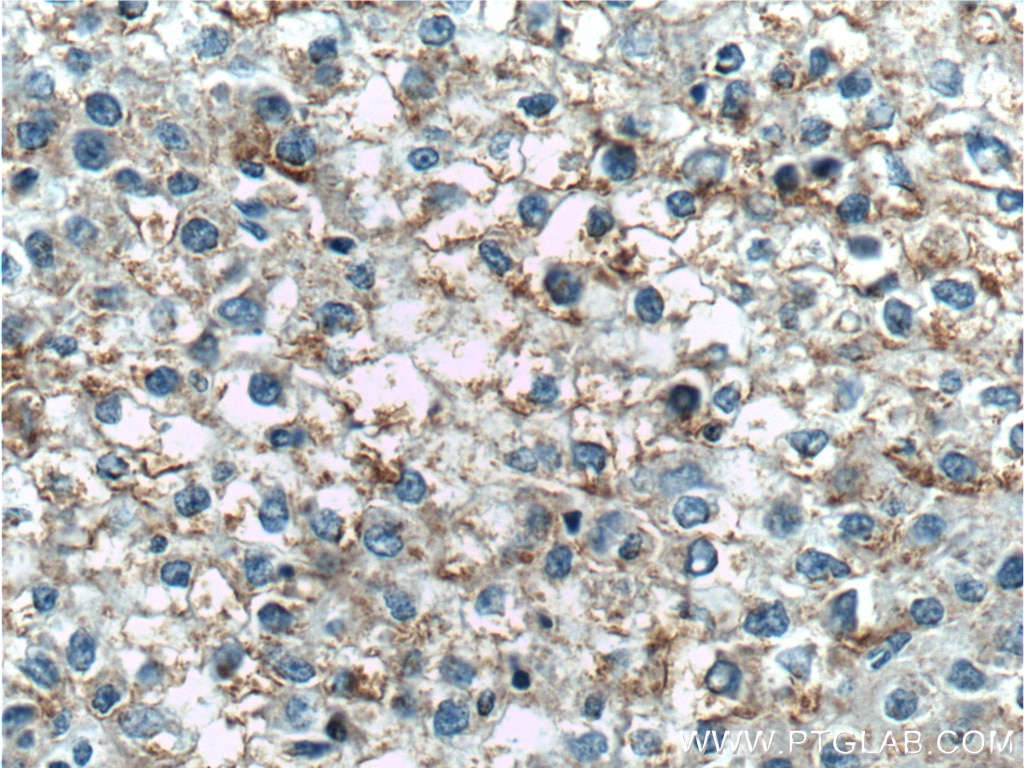 Immunohistochemistry (IHC) staining of human liver cancer tissue using TNFSF8 Polyclonal antibody (17852-1-AP)