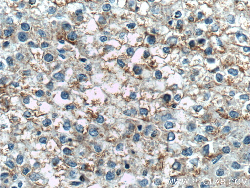 Immunohistochemistry (IHC) staining of human liver cancer tissue using TNFSF8 Polyclonal antibody (17852-1-AP)