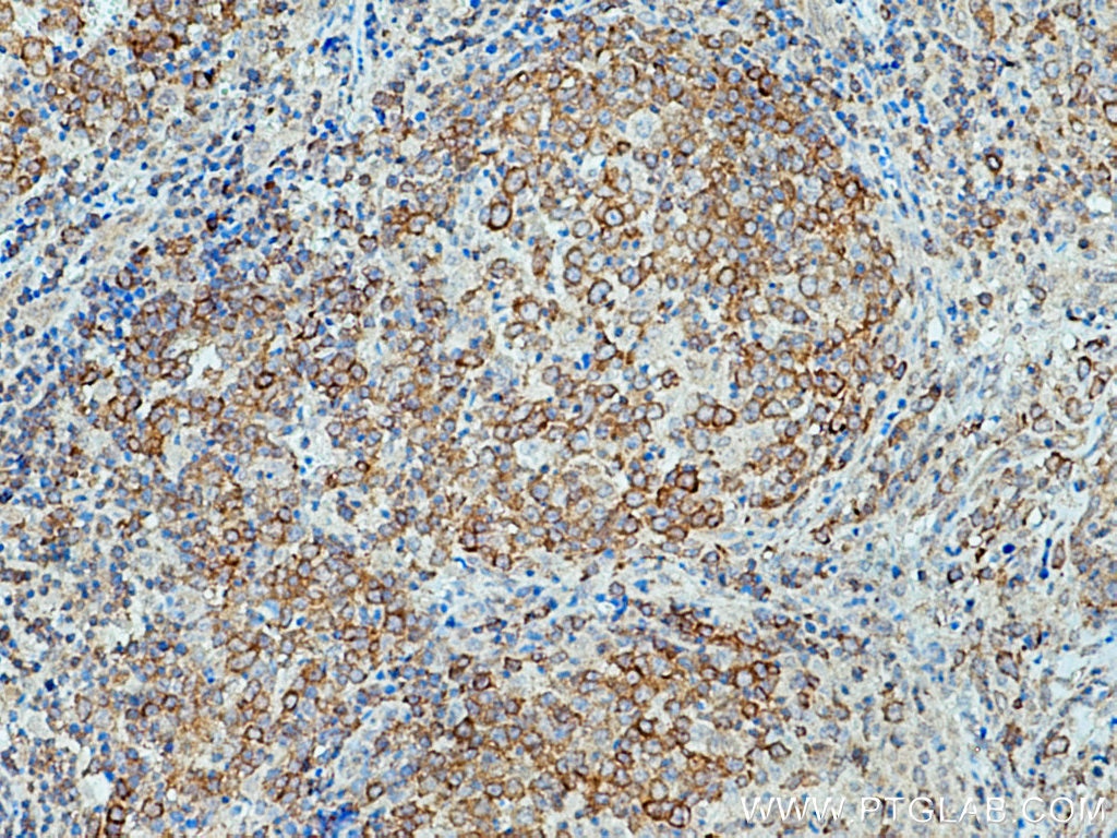Immunohistochemistry (IHC) staining of human lymphoma tissue using TNIP1 Polyclonal antibody (15104-1-AP)