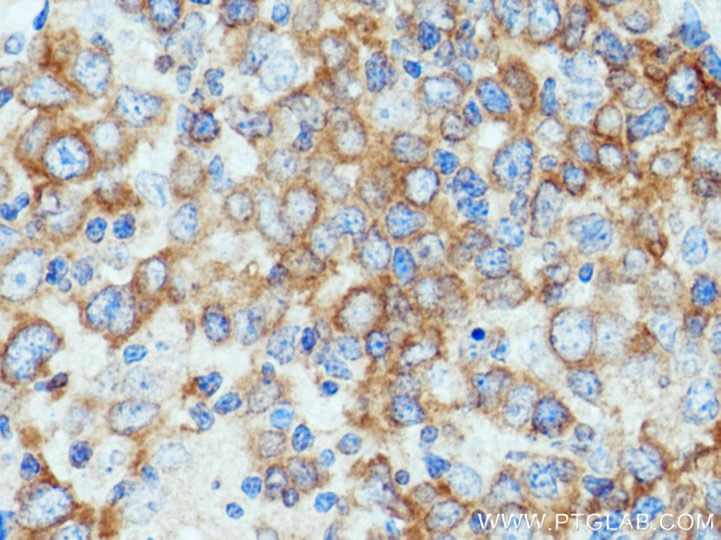Immunohistochemistry (IHC) staining of human lymphoma tissue using TNIP1 Polyclonal antibody (15104-1-AP)
