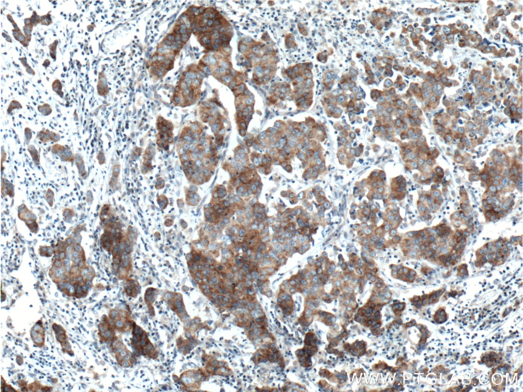 Immunohistochemistry (IHC) staining of human prostate cancer tissue using TNK1 Polyclonal antibody (14199-1-AP)