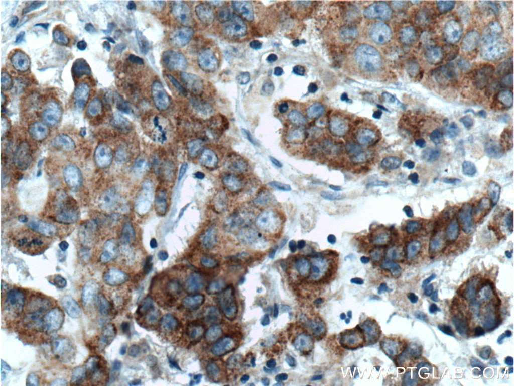 Immunohistochemistry (IHC) staining of human prostate cancer tissue using TNK1 Polyclonal antibody (14199-1-AP)
