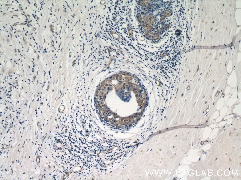 Immunohistochemistry (IHC) staining of human breast cancer tissue using ACK1 Polyclonal antibody (14304-1-AP)