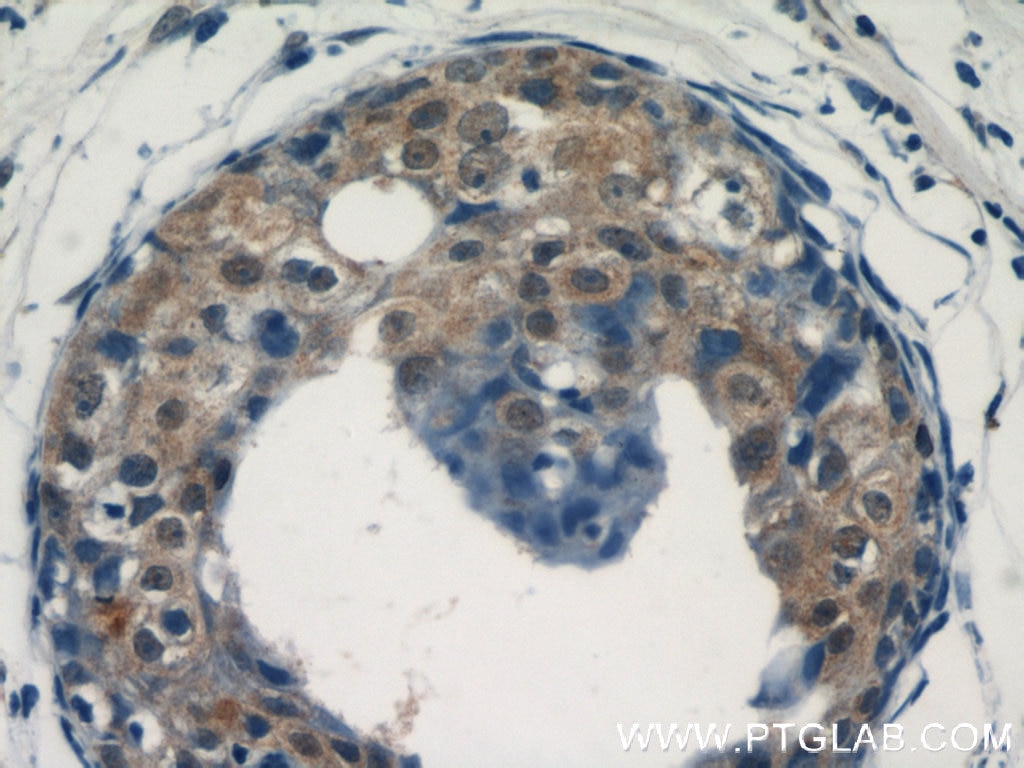 Immunohistochemistry (IHC) staining of human breast cancer tissue using ACK1 Polyclonal antibody (14304-1-AP)