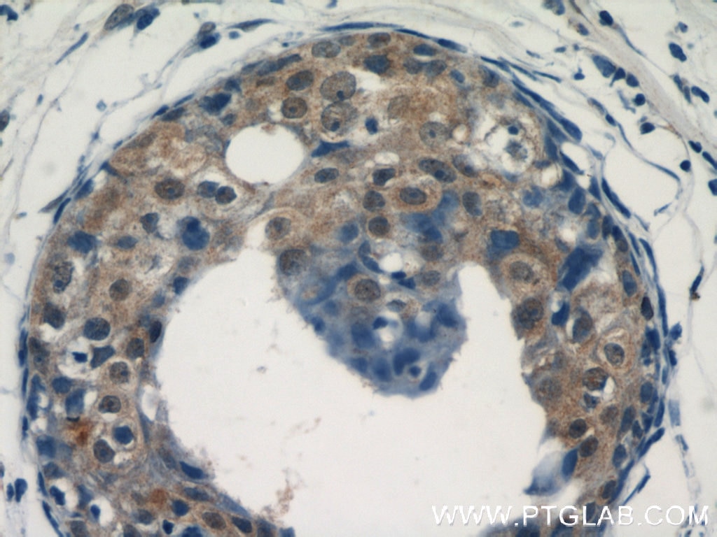 IHC staining of human breast cancer using 14304-1-AP