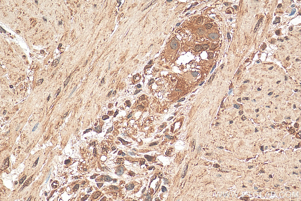 Immunohistochemistry (IHC) staining of human colon cancer tissue using TNKS Polyclonal antibody (18030-1-AP)