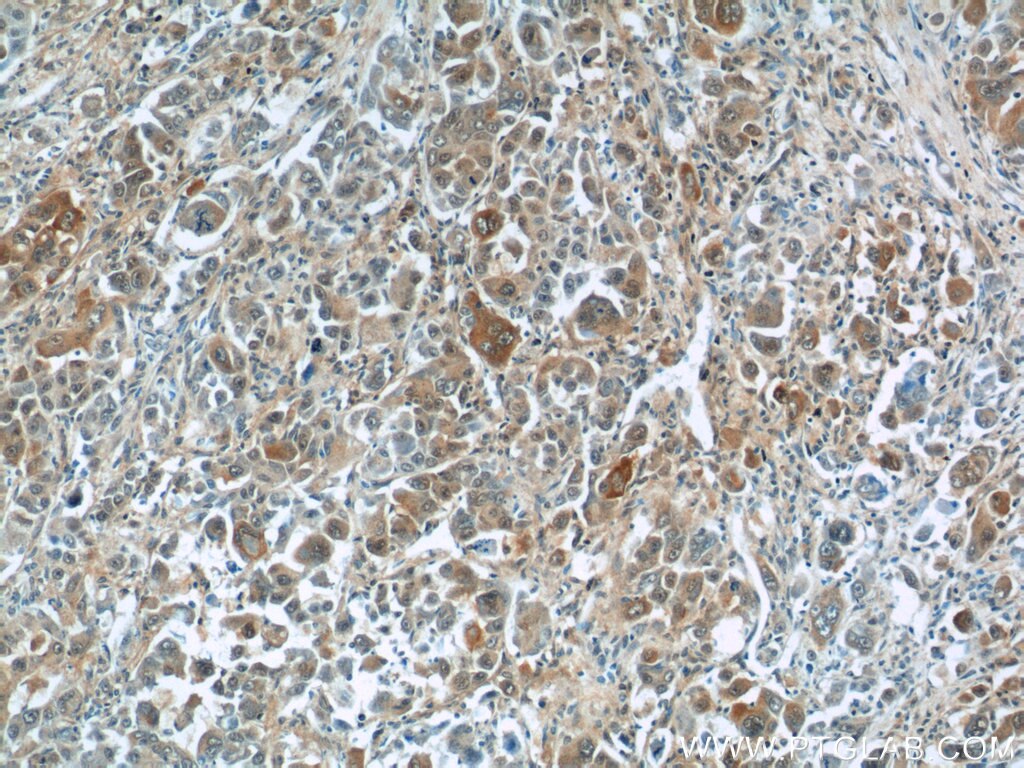 Immunohistochemistry (IHC) staining of human liver cancer tissue using TNS4 Polyclonal antibody (11580-1-AP)