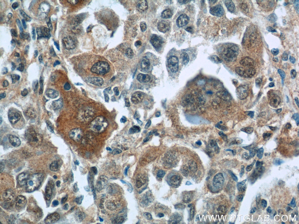 Immunohistochemistry (IHC) staining of human liver cancer tissue using TNS4 Polyclonal antibody (11580-1-AP)