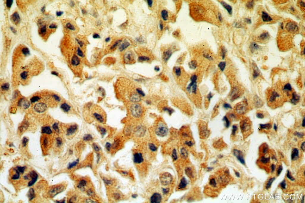Immunohistochemistry (IHC) staining of human breast cancer tissue using Tenascin-X Polyclonal antibody (13595-1-AP)