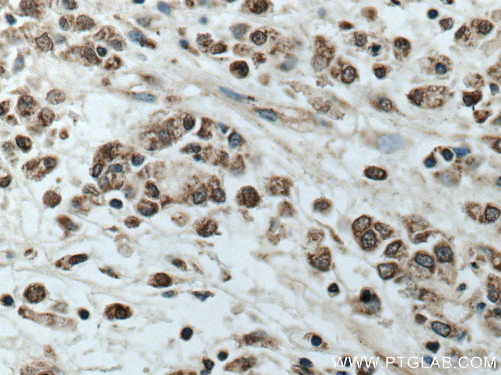 Immunohistochemistry (IHC) staining of human stomach cancer tissue using TOB1 Polyclonal antibody (14915-1-AP)