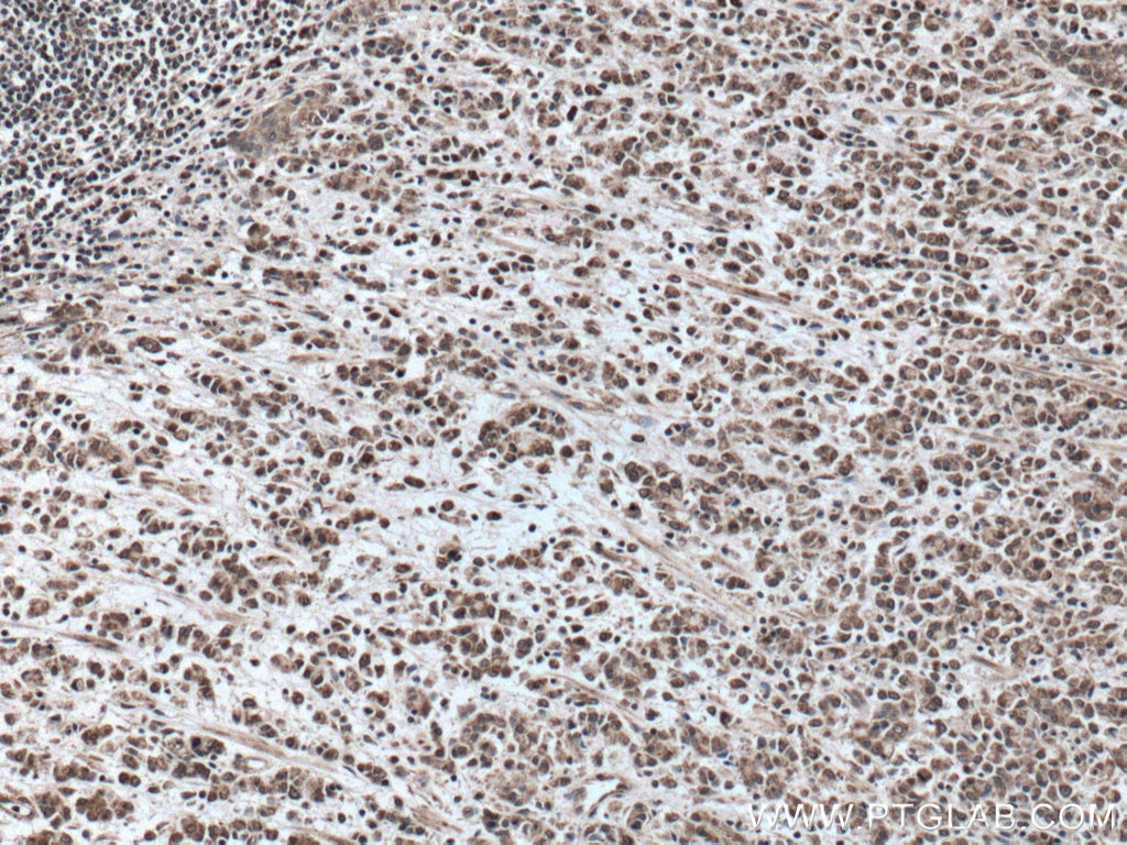 Immunohistochemistry (IHC) staining of human stomach cancer tissue using TOB1 Polyclonal antibody (14915-1-AP)