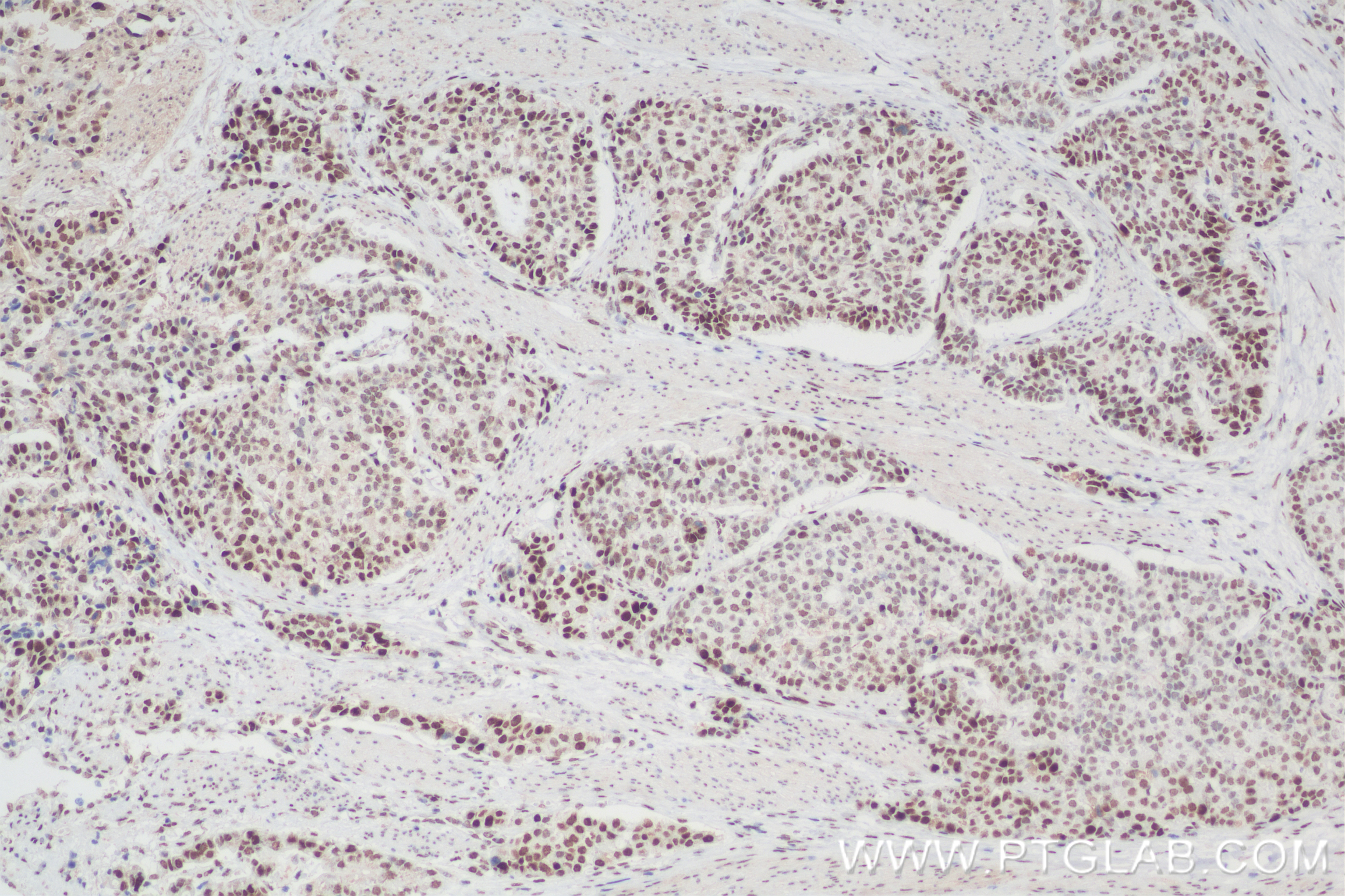 Immunohistochemistry (IHC) staining of human stomach cancer tissue using TOB1 Recombinant antibody (83944-2-RR)