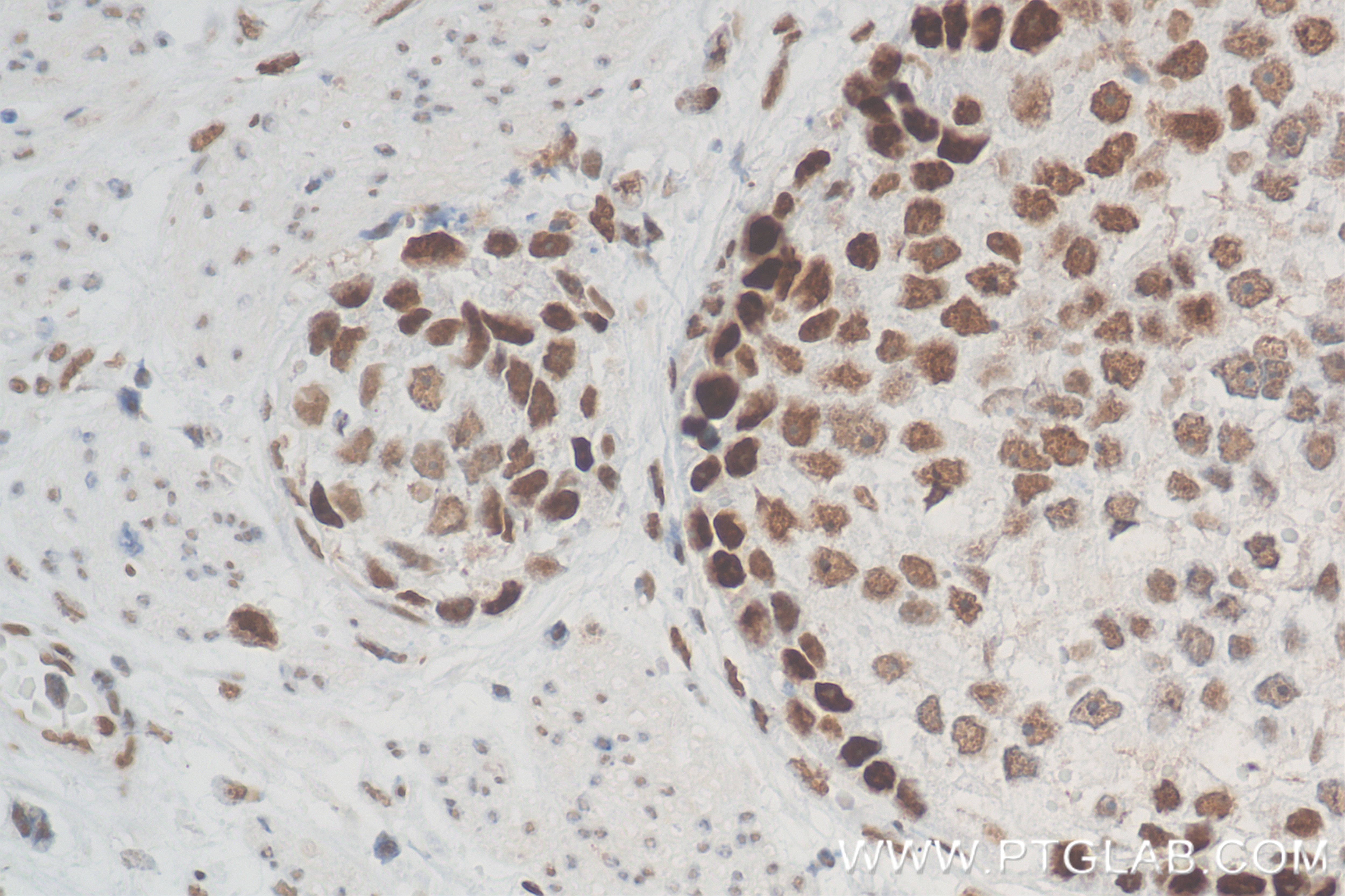 Immunohistochemistry (IHC) staining of human stomach cancer tissue using TOB1 Recombinant antibody (83944-2-RR)