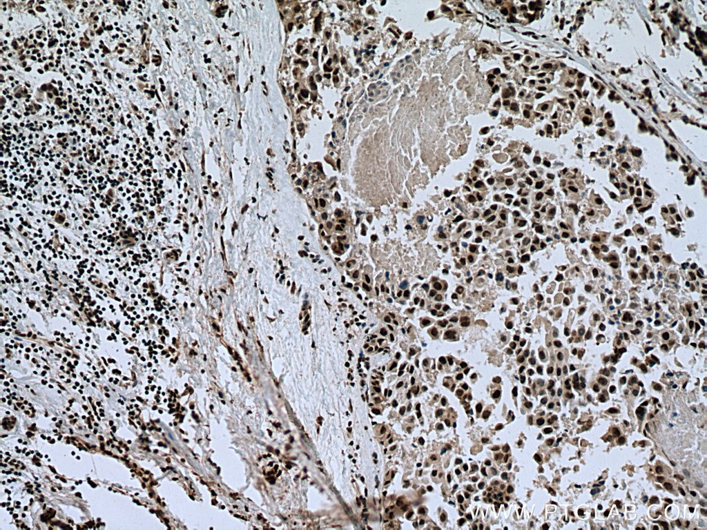 Immunohistochemistry (IHC) staining of human breast cancer tissue using TOE1 Polyclonal antibody (16203-1-AP)