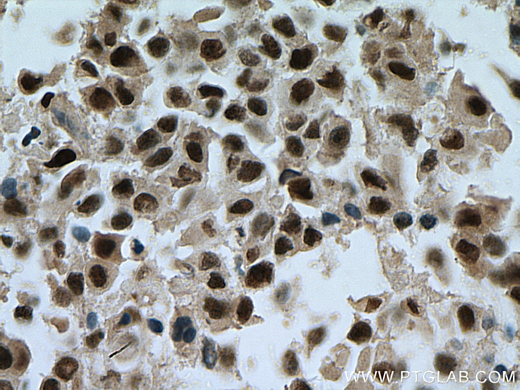 Immunohistochemistry (IHC) staining of human breast cancer tissue using TOE1 Polyclonal antibody (16203-1-AP)