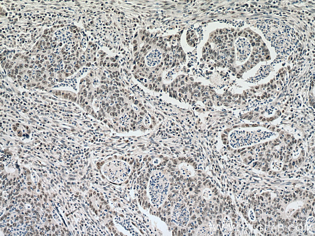 IHC staining of human colon cancer using 16203-1-AP