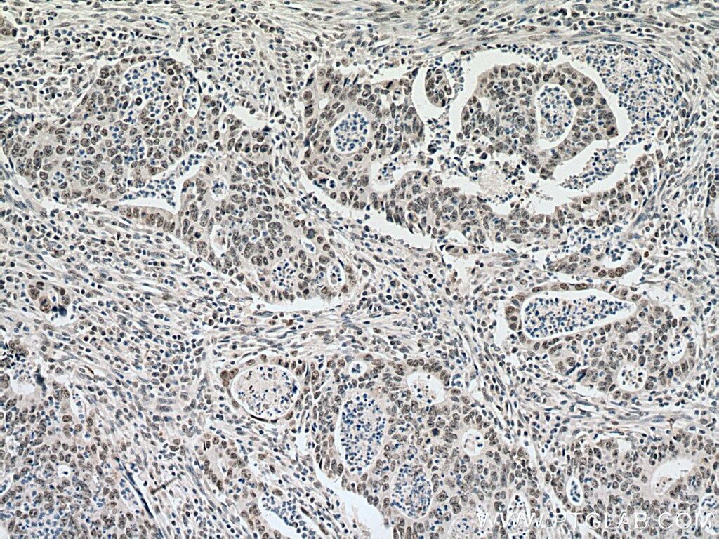 Immunohistochemistry (IHC) staining of human colon cancer tissue using TOE1 Polyclonal antibody (16203-1-AP)