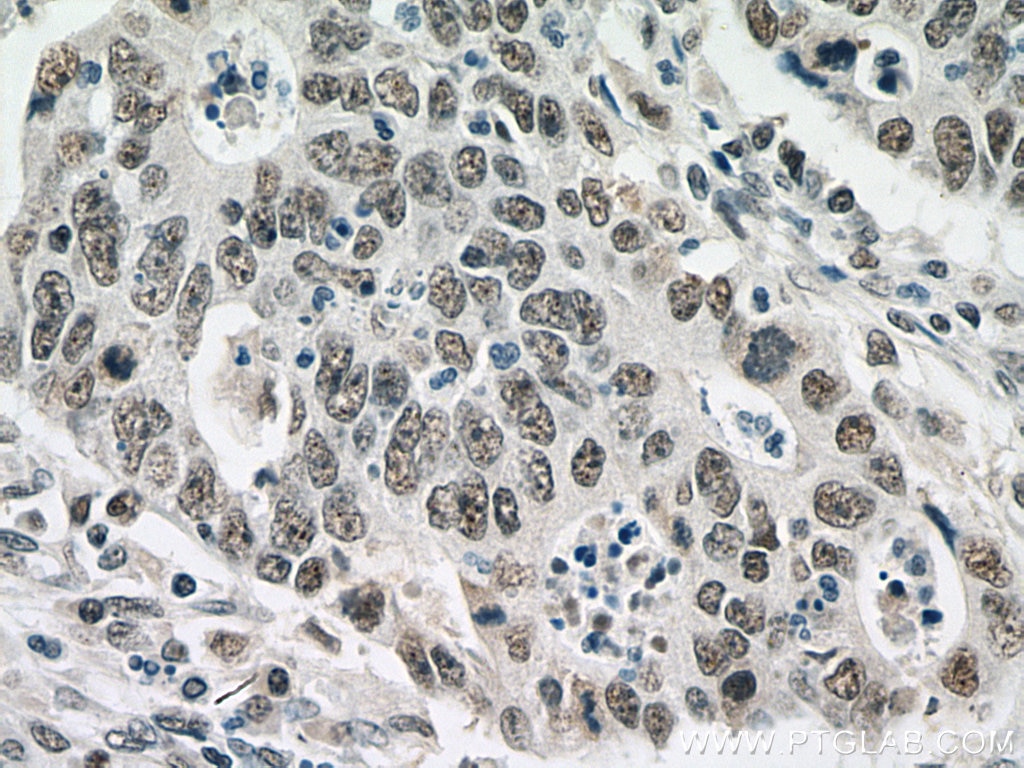 Immunohistochemistry (IHC) staining of human colon cancer tissue using TOE1 Polyclonal antibody (16203-1-AP)