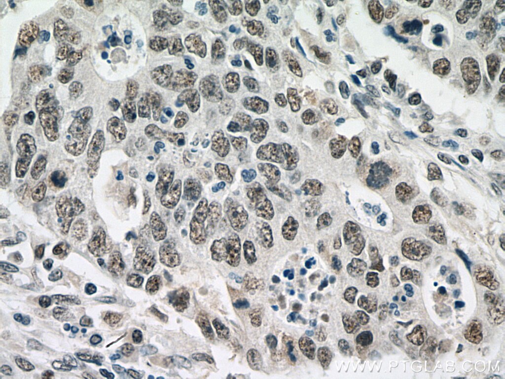 IHC staining of human colon cancer using 16203-1-AP