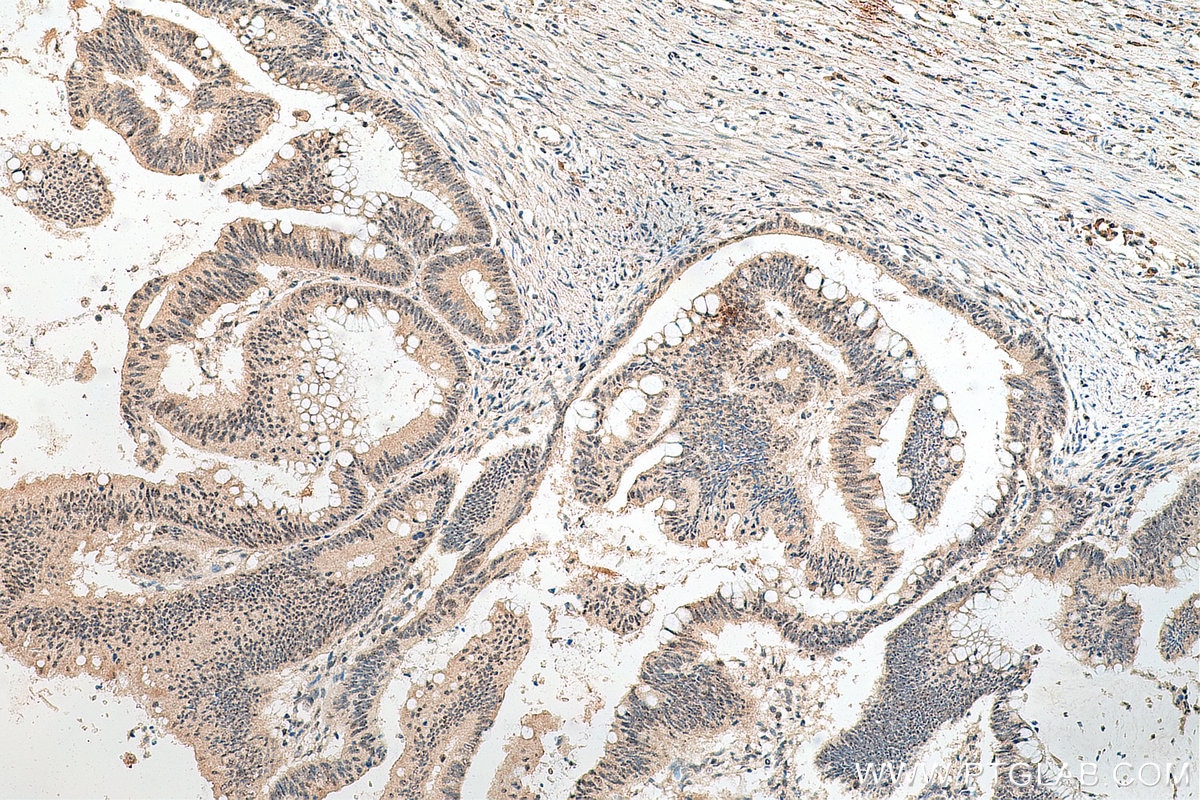Immunohistochemistry (IHC) staining of human colon cancer tissue using TOE1 Monoclonal antibody (67829-1-Ig)