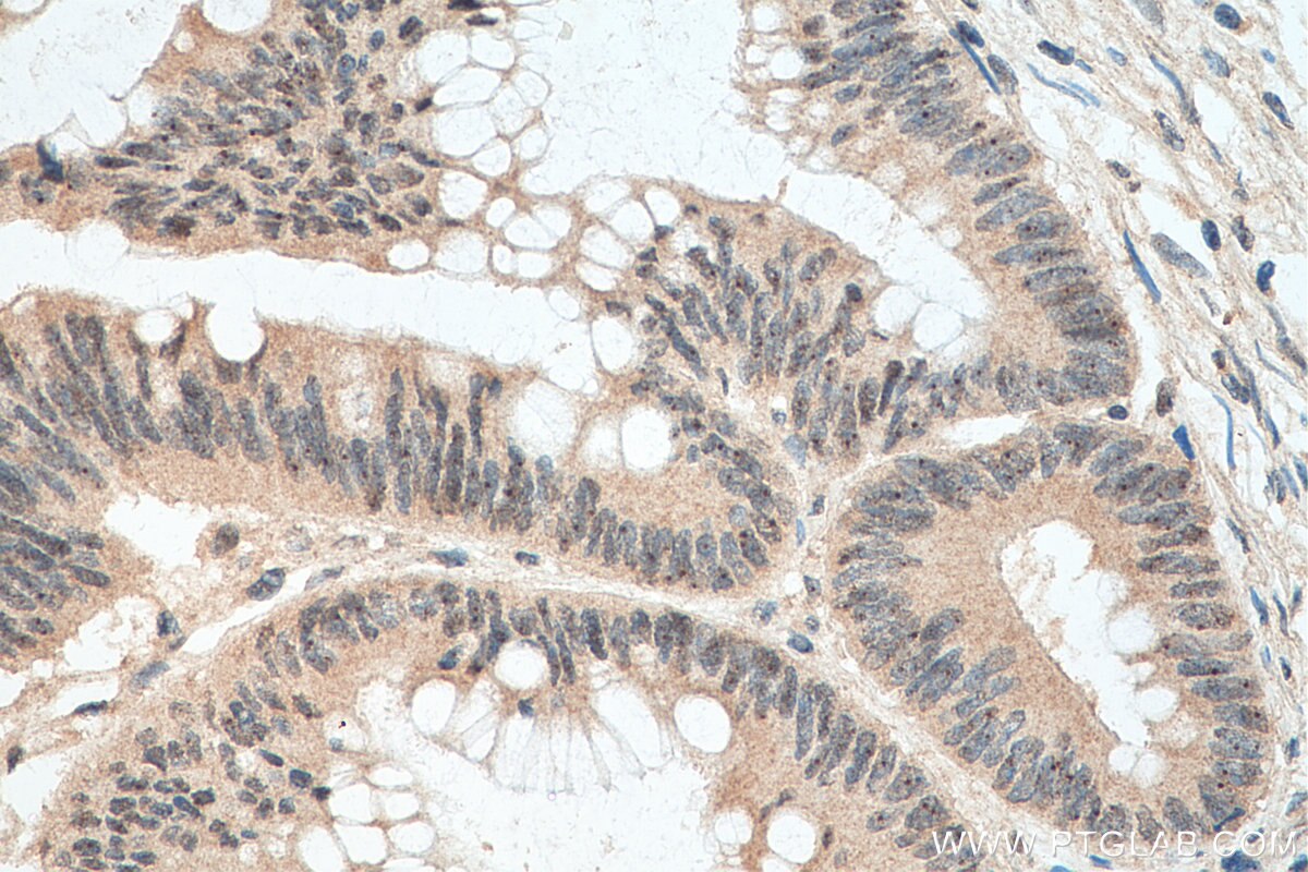 Immunohistochemistry (IHC) staining of human colon cancer tissue using TOE1 Monoclonal antibody (67829-1-Ig)