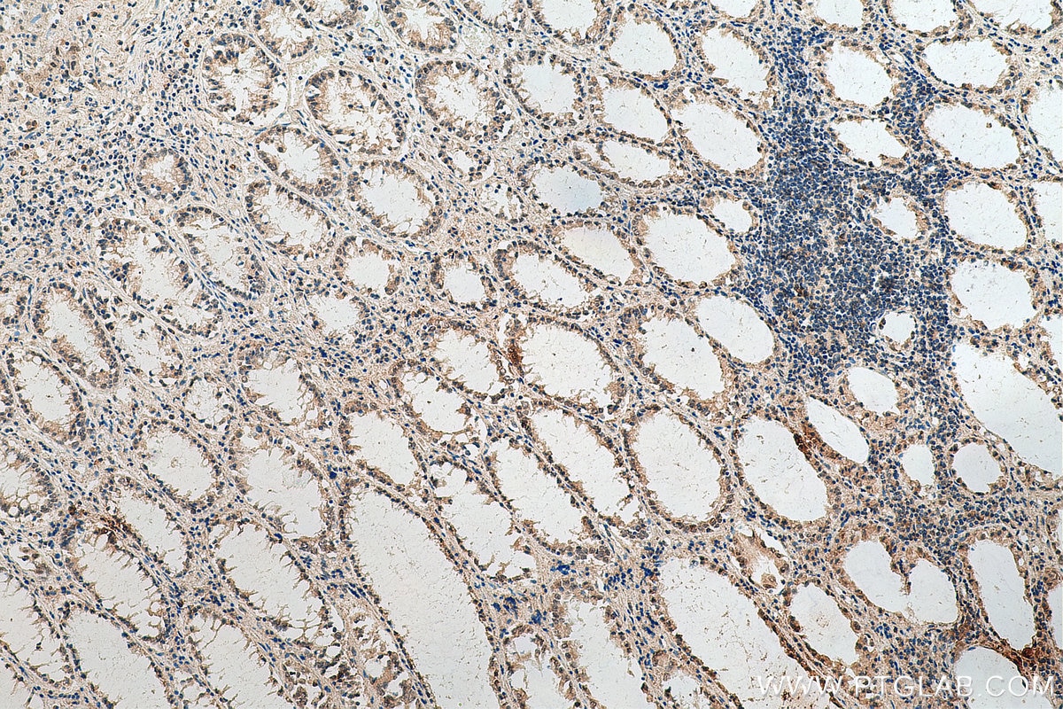 Immunohistochemistry (IHC) staining of human colon cancer tissue using TOE1 Monoclonal antibody (67829-1-Ig)