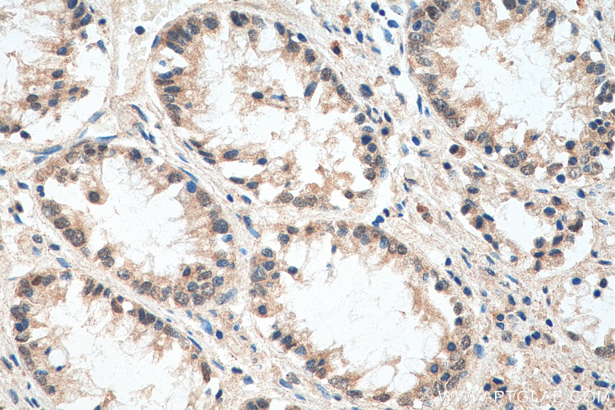Immunohistochemistry (IHC) staining of human colon cancer tissue using TOE1 Monoclonal antibody (67829-1-Ig)