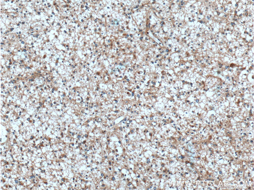 Immunohistochemistry (IHC) staining of human gliomas tissue using TOLLIP Polyclonal antibody (11315-1-AP)