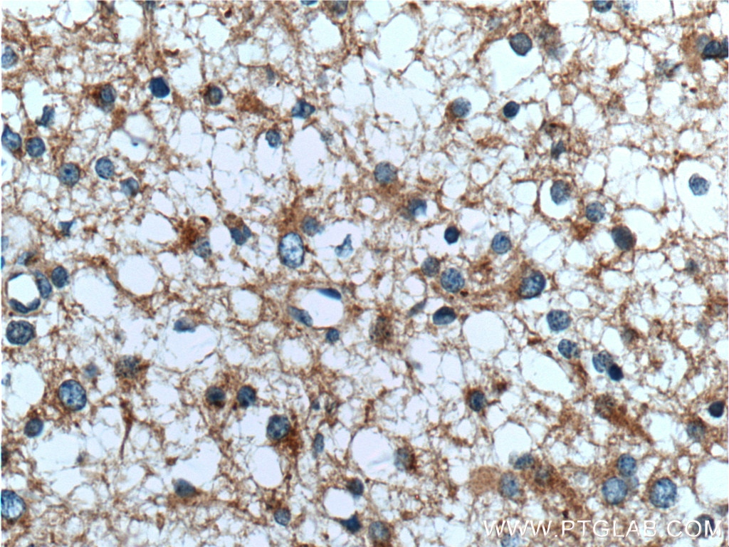 Immunohistochemistry (IHC) staining of human gliomas tissue using TOLLIP Polyclonal antibody (11315-1-AP)