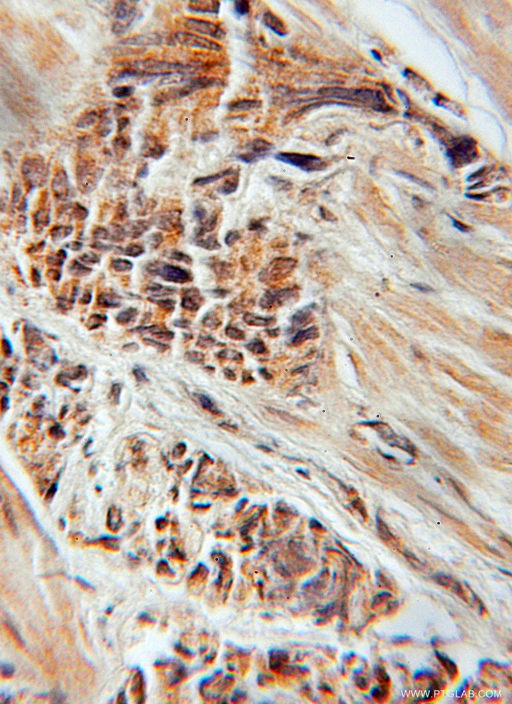 Immunohistochemistry (IHC) staining of human prostate cancer tissue using TOM1L1 Polyclonal antibody (51017-1-AP)