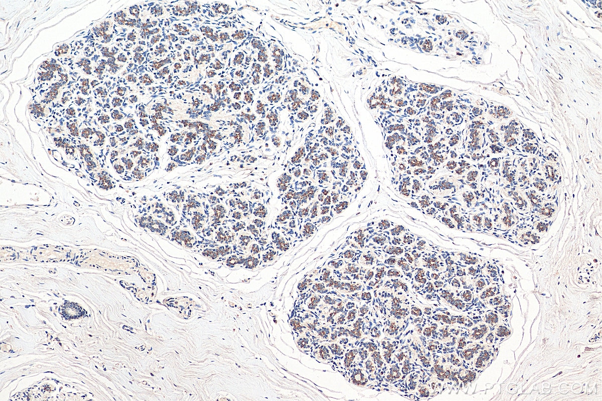Immunohistochemistry (IHC) staining of human breast cancer tissue using TOM20 Monoclonal antibody (66777-1-Ig)