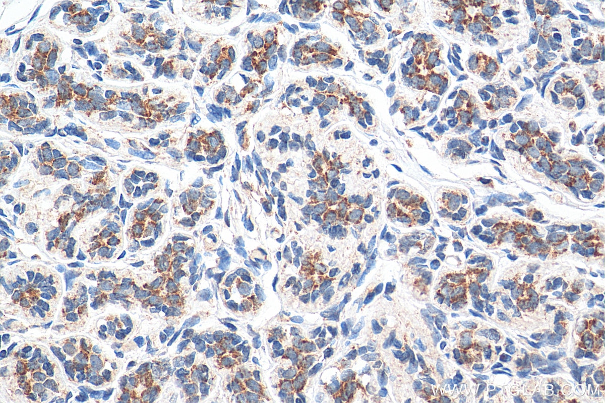 Immunohistochemistry (IHC) staining of human breast cancer tissue using TOM20 Monoclonal antibody (66777-1-Ig)