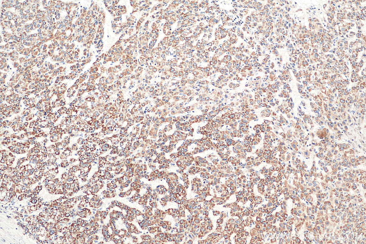 Immunohistochemistry (IHC) staining of human liver cancer tissue using TOM20 Monoclonal antibody (66777-1-Ig)