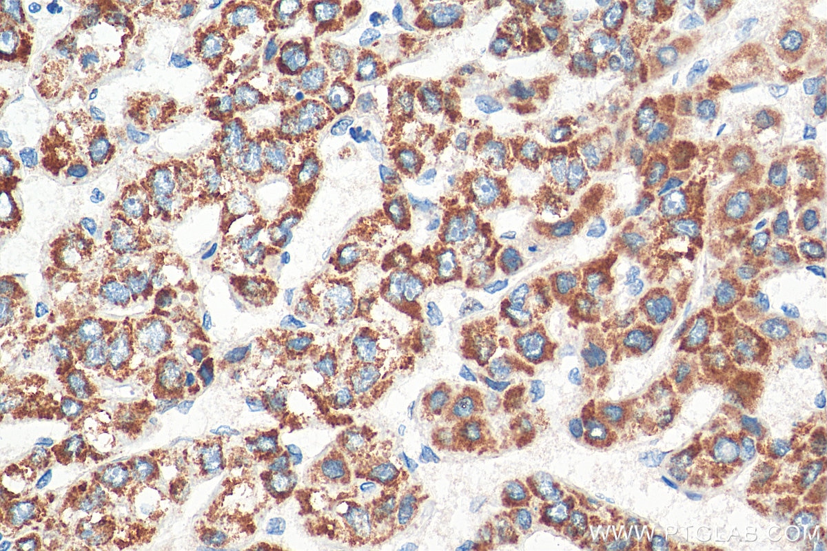 Immunohistochemistry (IHC) staining of human liver cancer tissue using TOM20 Monoclonal antibody (66777-1-Ig)