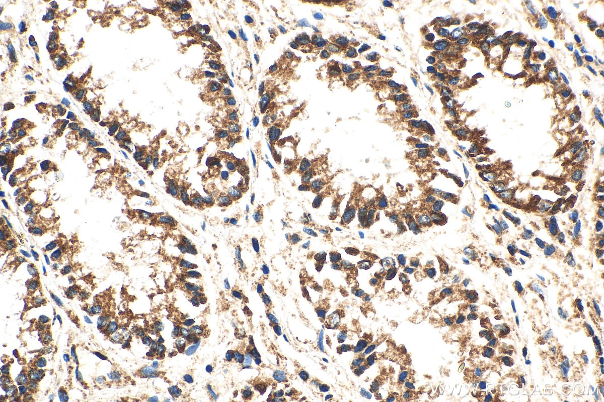 Immunohistochemistry (IHC) staining of human colon cancer tissue using Tom22 Polyclonal antibody (11278-1-AP)