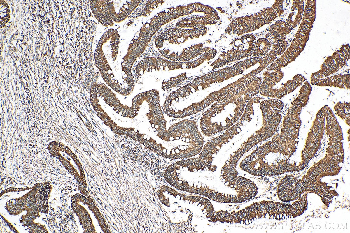 Immunohistochemistry (IHC) staining of human colon cancer tissue using Tom22 Polyclonal antibody (11278-1-AP)