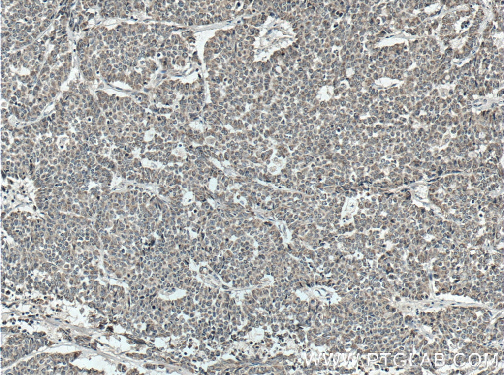 Immunohistochemistry (IHC) staining of human colon cancer tissue using Tom22 Monoclonal antibody (66562-1-Ig)