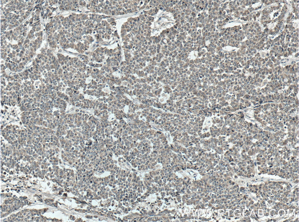 IHC staining of human colon cancer using 66562-1-Ig