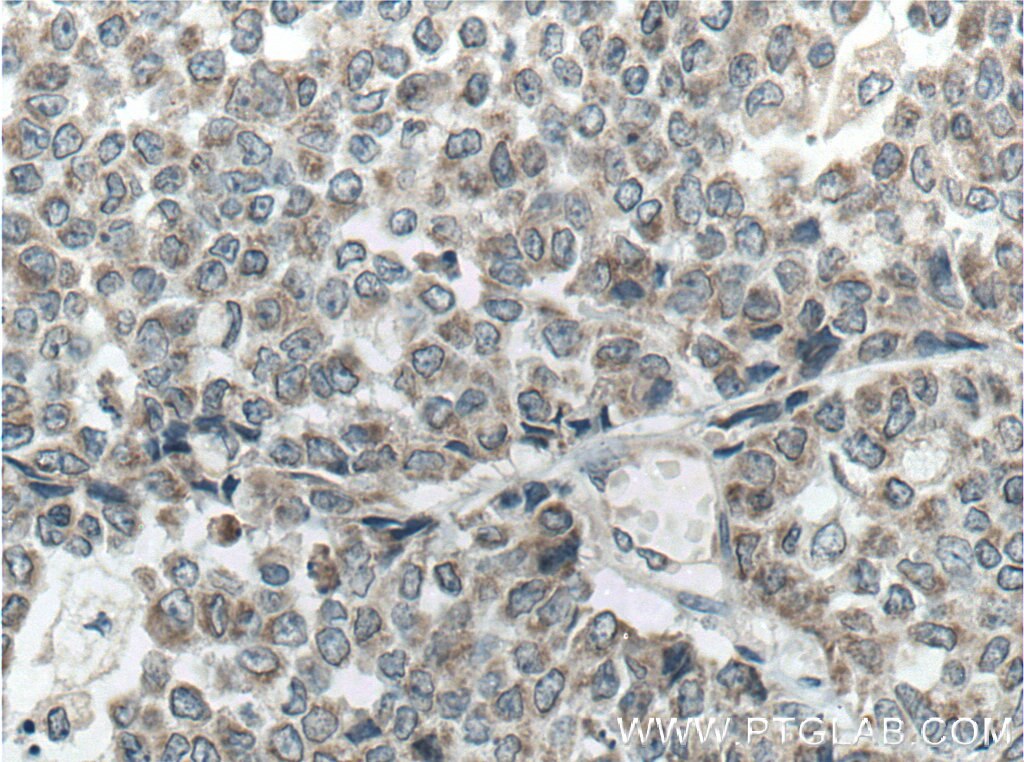 Immunohistochemistry (IHC) staining of human colon cancer tissue using Tom22 Monoclonal antibody (66562-1-Ig)