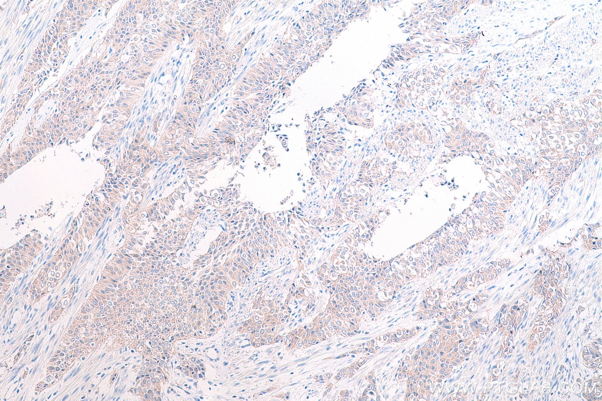 Immunohistochemistry (IHC) staining of human urothelial carcinoma tissue using TOMM34 Polyclonal antibody (12196-1-AP)