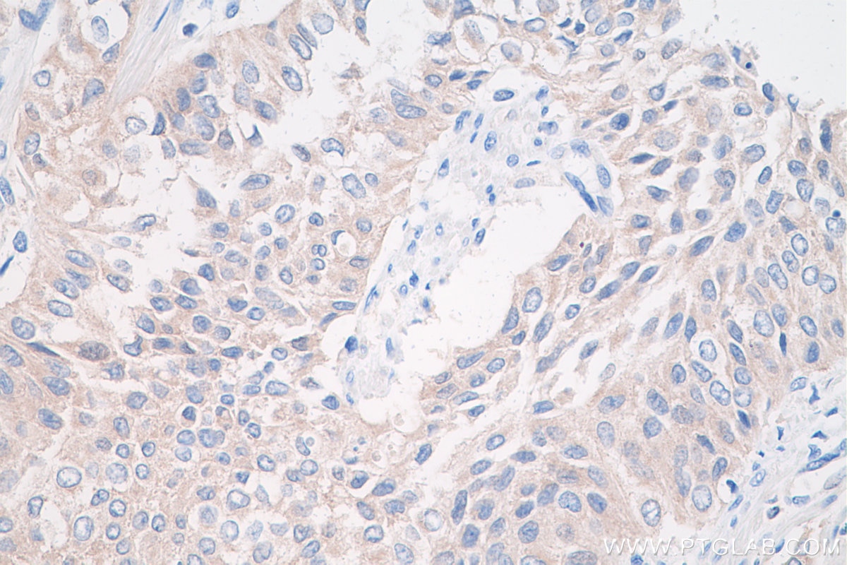 Immunohistochemistry (IHC) staining of human urothelial carcinoma tissue using TOMM34 Polyclonal antibody (12196-1-AP)