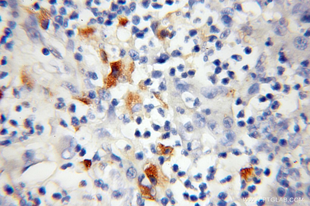 Immunohistochemistry (IHC) staining of human colon cancer tissue using TOMM34 Polyclonal antibody (12196-1-AP)