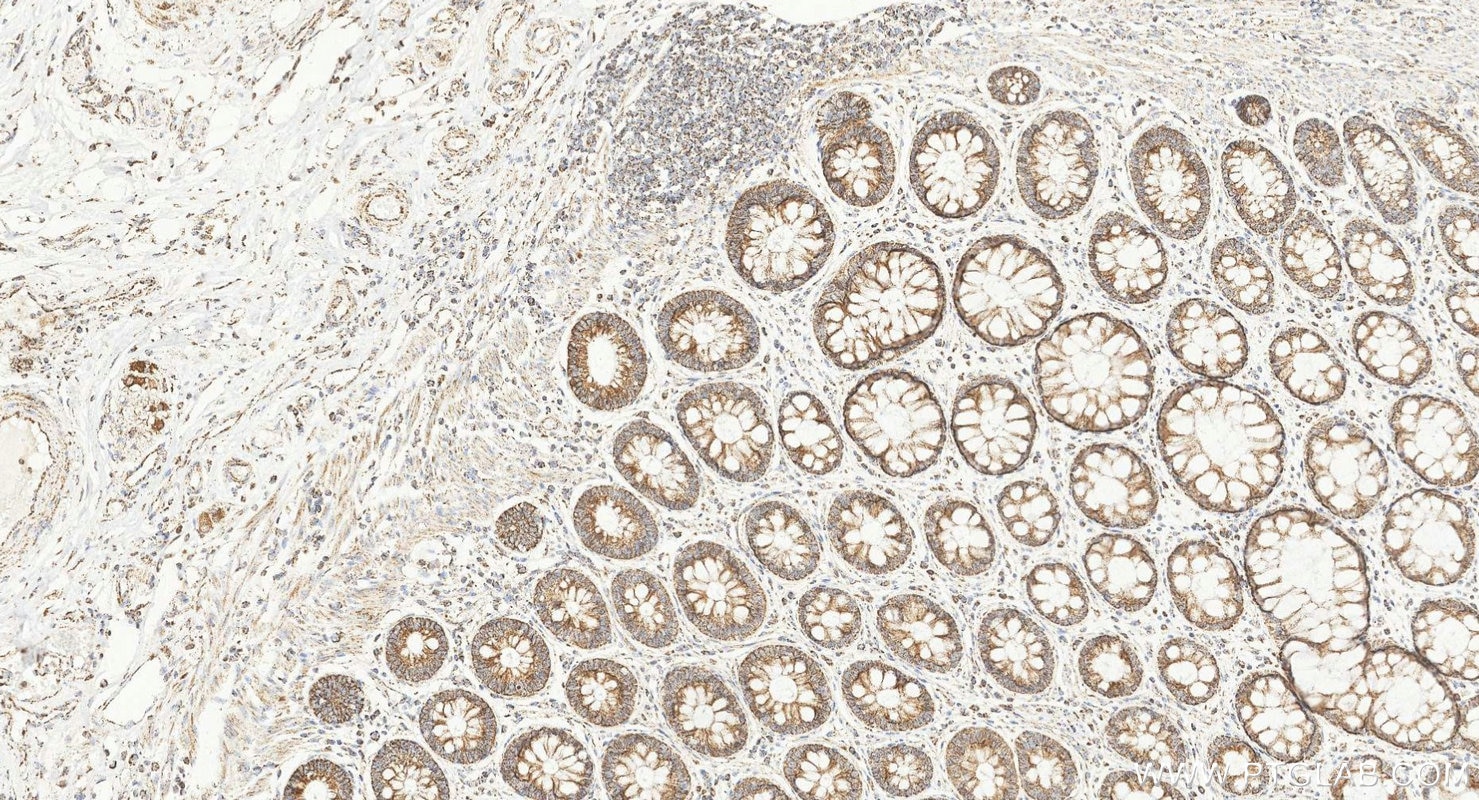 IHC staining of human colorectal cancer using 25607-1-AP Immunohistochemistry (IHC) staining of human colorectal cancer tissue using TOMM5 Polyclonal antibody (25607-1-AP)
