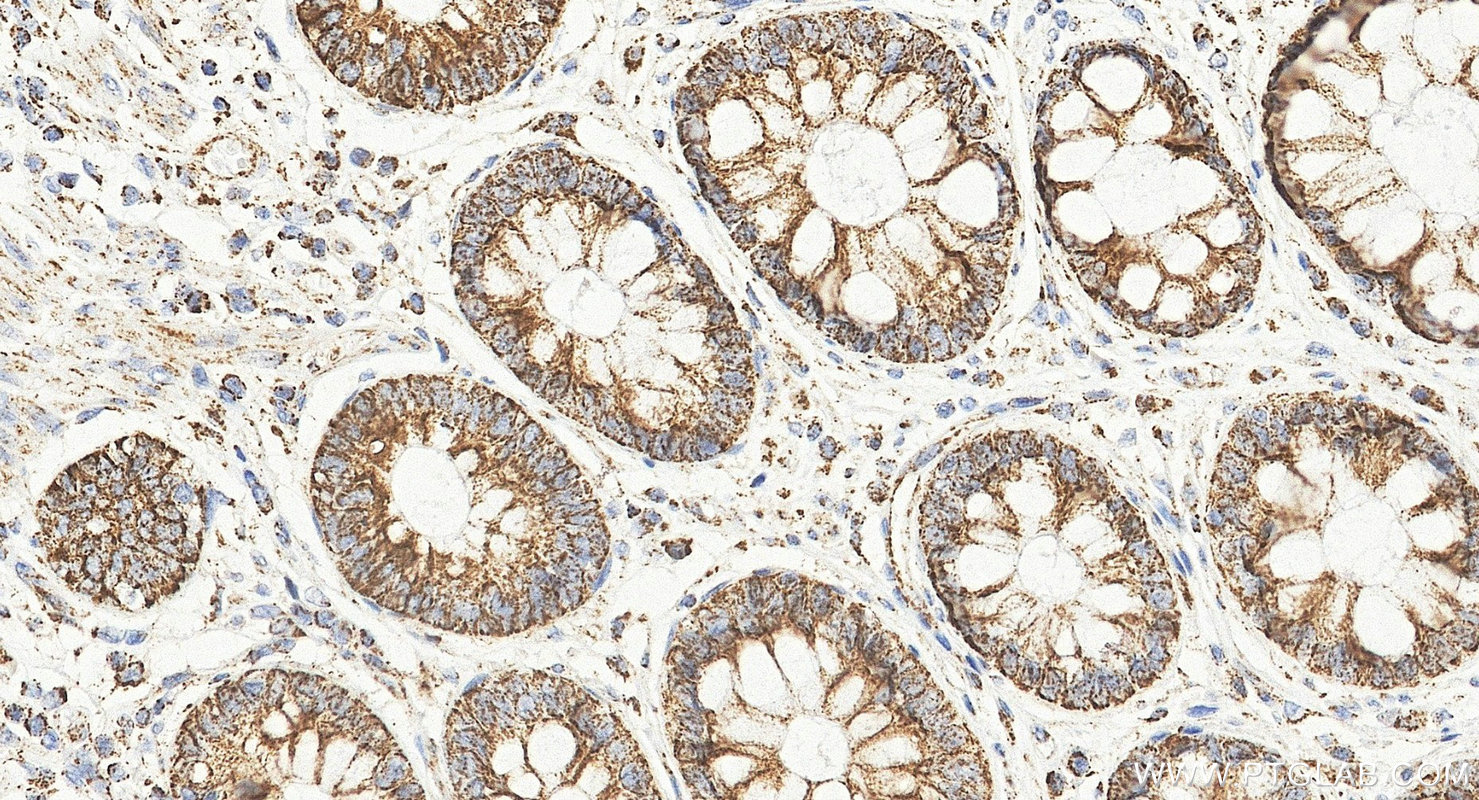 IHC staining of human colorectal cancer using 25607-1-AP Immunohistochemistry (IHC) staining of human colorectal cancer tissue using TOMM5 Polyclonal antibody (25607-1-AP)